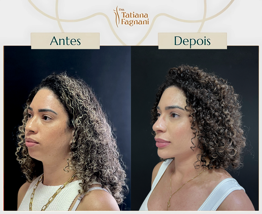 Antes e depois perfil sol 2