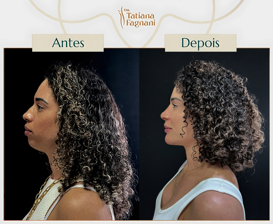 Antes e depois perfil sol